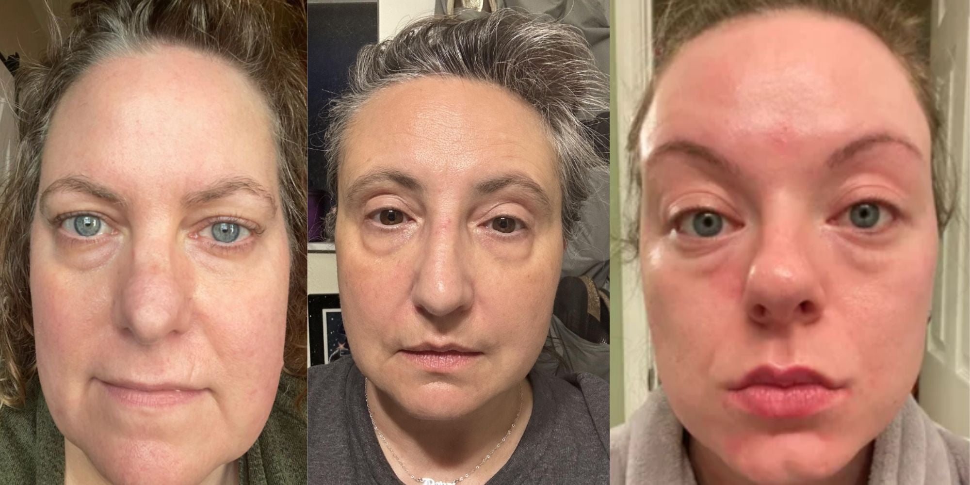 Woman applying under Eye Patches to reduce wrinkles and dark circles