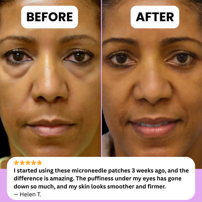 NOVELIA Microneedle Patches