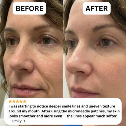 NOVELIA Microneedle Patches