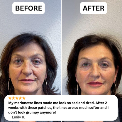 NOVELIA Microneedle Patches