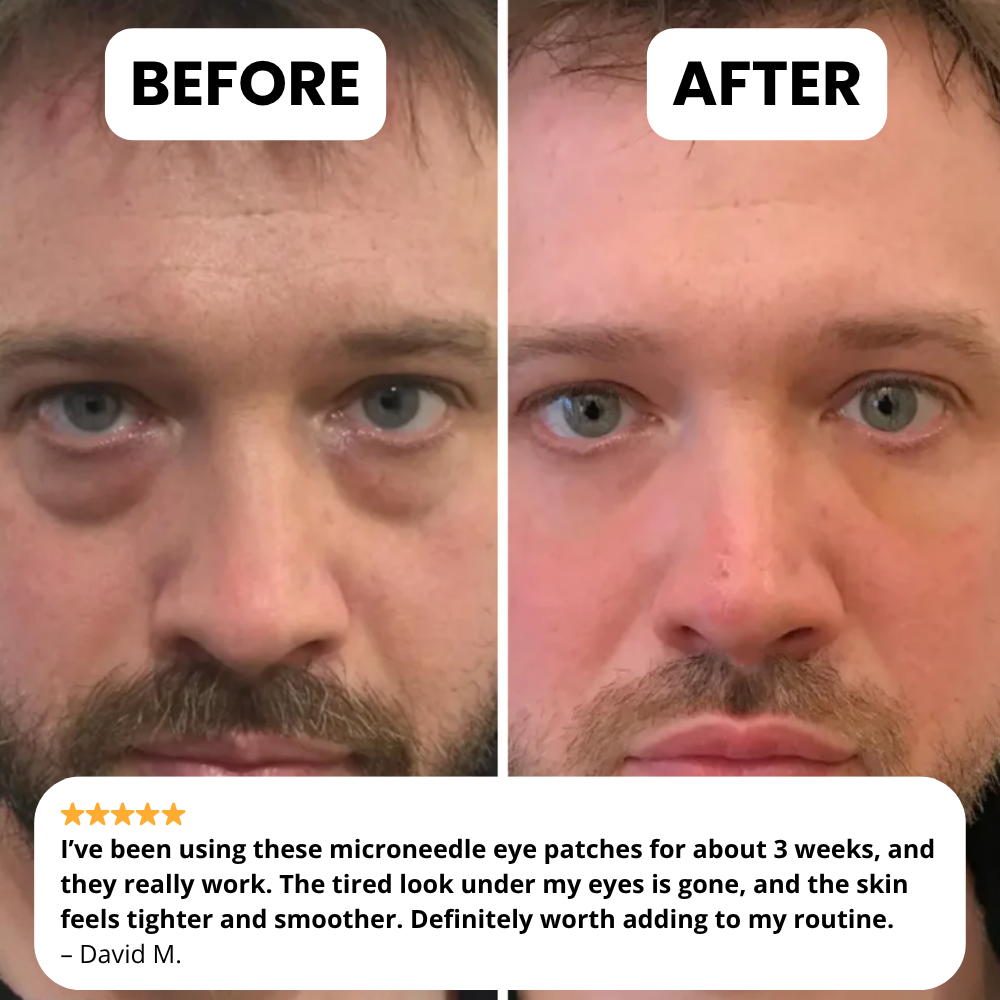 Novelia Microneedle Patches