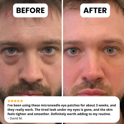 Novelia Microneedle Patches